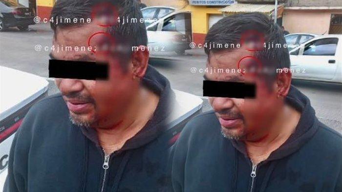 Aneh Tapi Nyata, Pria Ini Ditembak 2 Kali di Kepala Tidak Mati