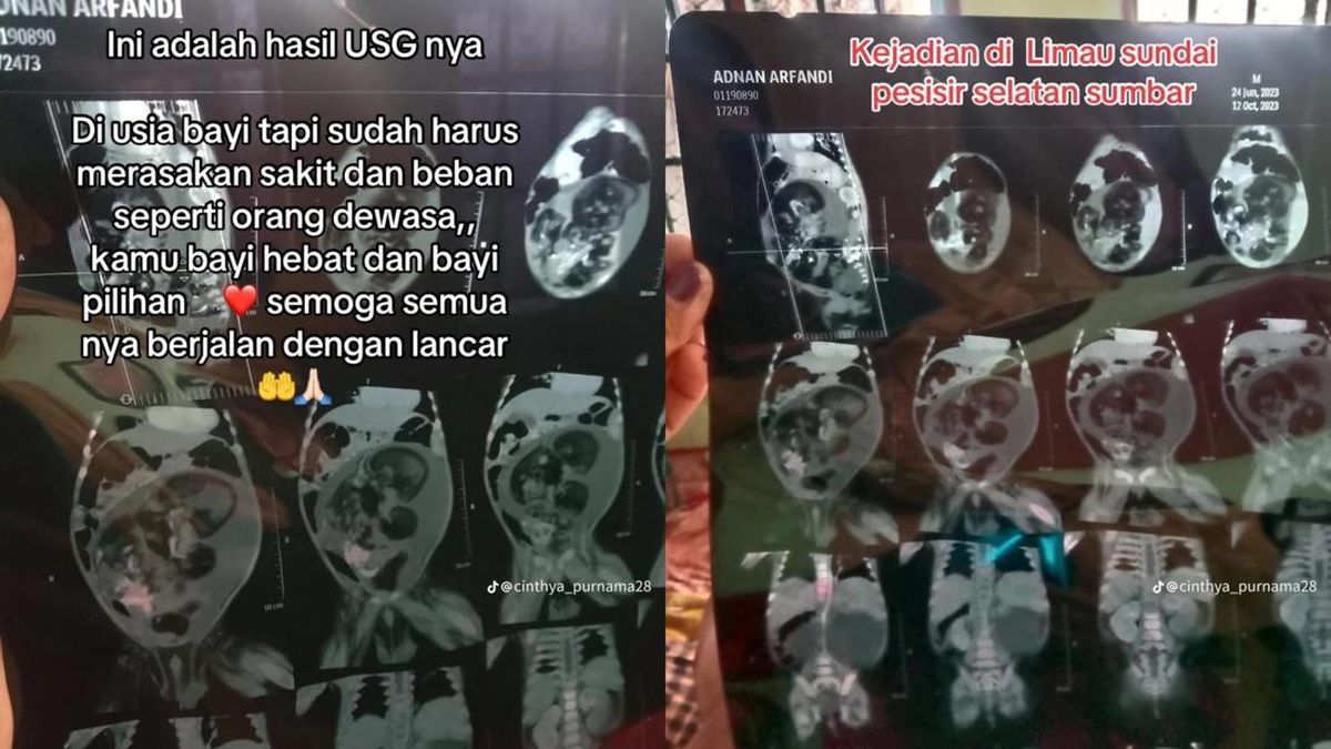 Bayi Hamil di Padang Jalani Operasi Penangkatan Janin Parasit