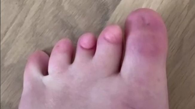 Curhat Influencer Terlahir Tanpa Kuku Kaki, Ternyata Idap Sindrom Langka