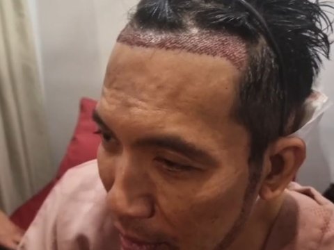 Desta Jalani Transplantasi Rambut di Klinik Tompi, Akui Tidak Ada Rasa Sakit