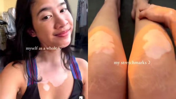 Kena Vitiligo, Dokter Salma Berjuang Lawan Insecure hingga Sukses Jadi Model