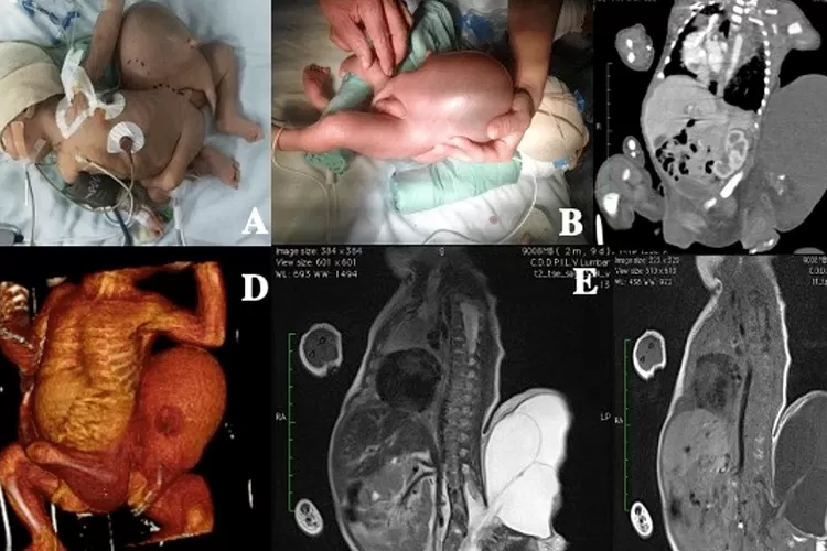 Kisah Nyata Bayi Hamil di Sumbar Bikin Geger, Alami Fetus in Fetu