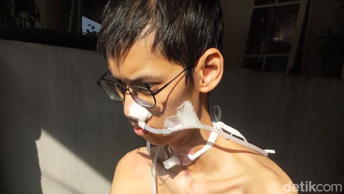 Leher Mahasiswa Terjerat Kabel Fiber Optik di Jaksel, 7 Bulan Tak Bisa Bicara