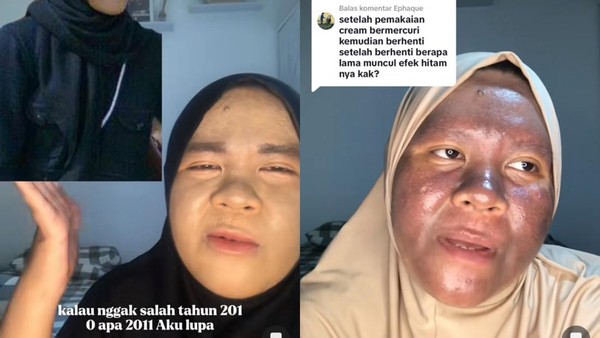 Viral Wajah Wanita Kaltim Menggosong Bertahun tahun Pakai Krim Merkuri