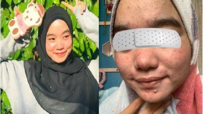 Viral Wajah Wanita Kaltim Menggosong Bertahun tahun Pakai Krim Merkuri